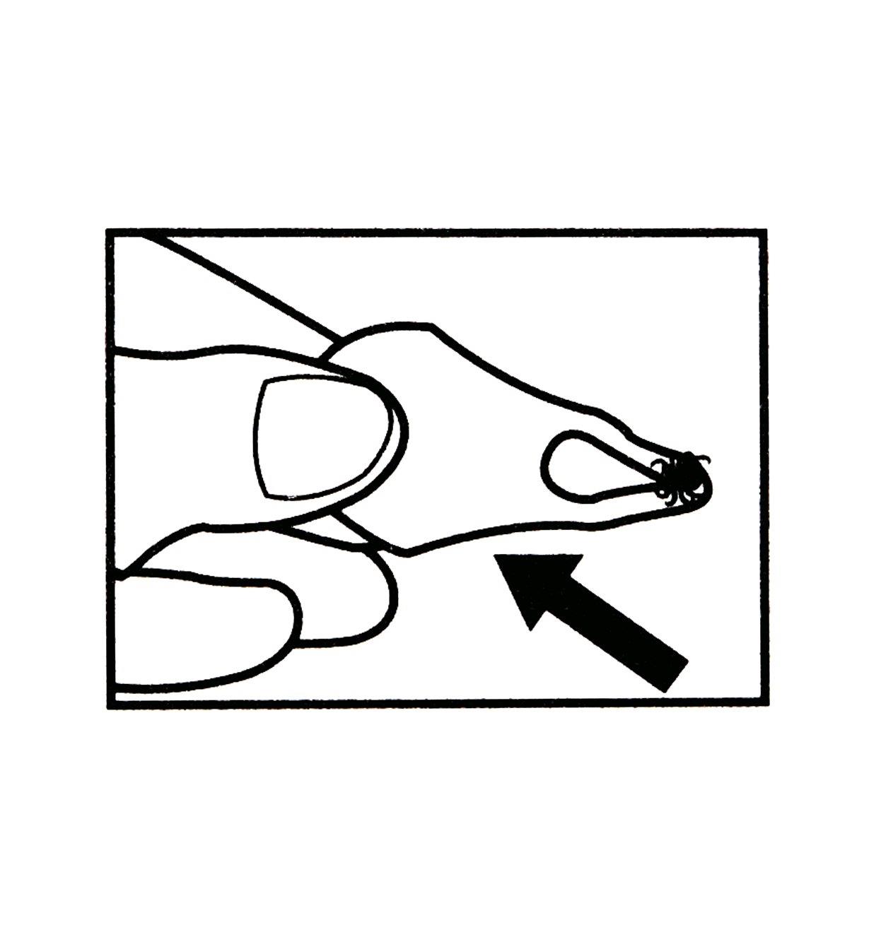 Illustration shows how to pull the tick key away from the skin and remove the tick
