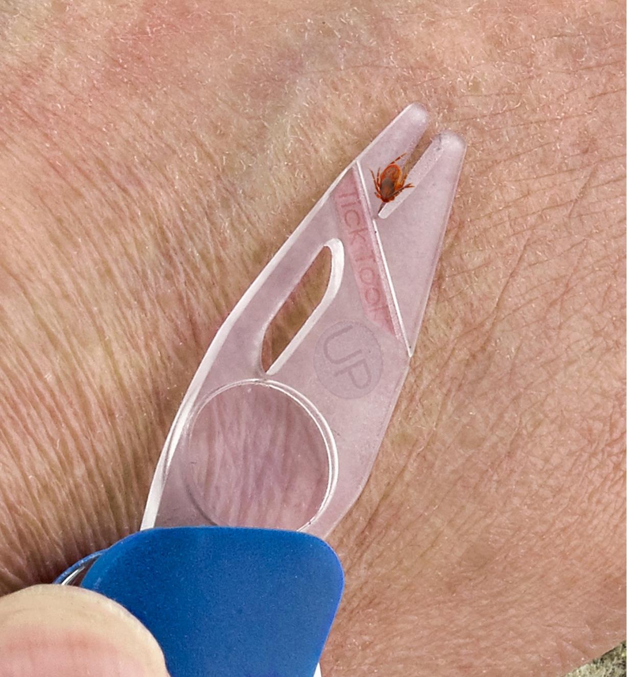Dislodging a tick from skin with the tick remove